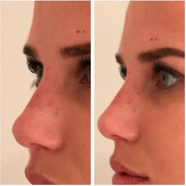 Refinamiento nasal - antes
